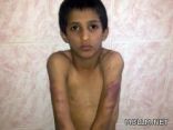 معلّم يعتدي بالضرب المبرح على طالبيْن في ابتدائية الحفاير